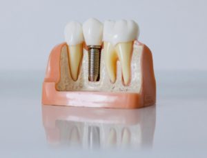 Dental image cast model
