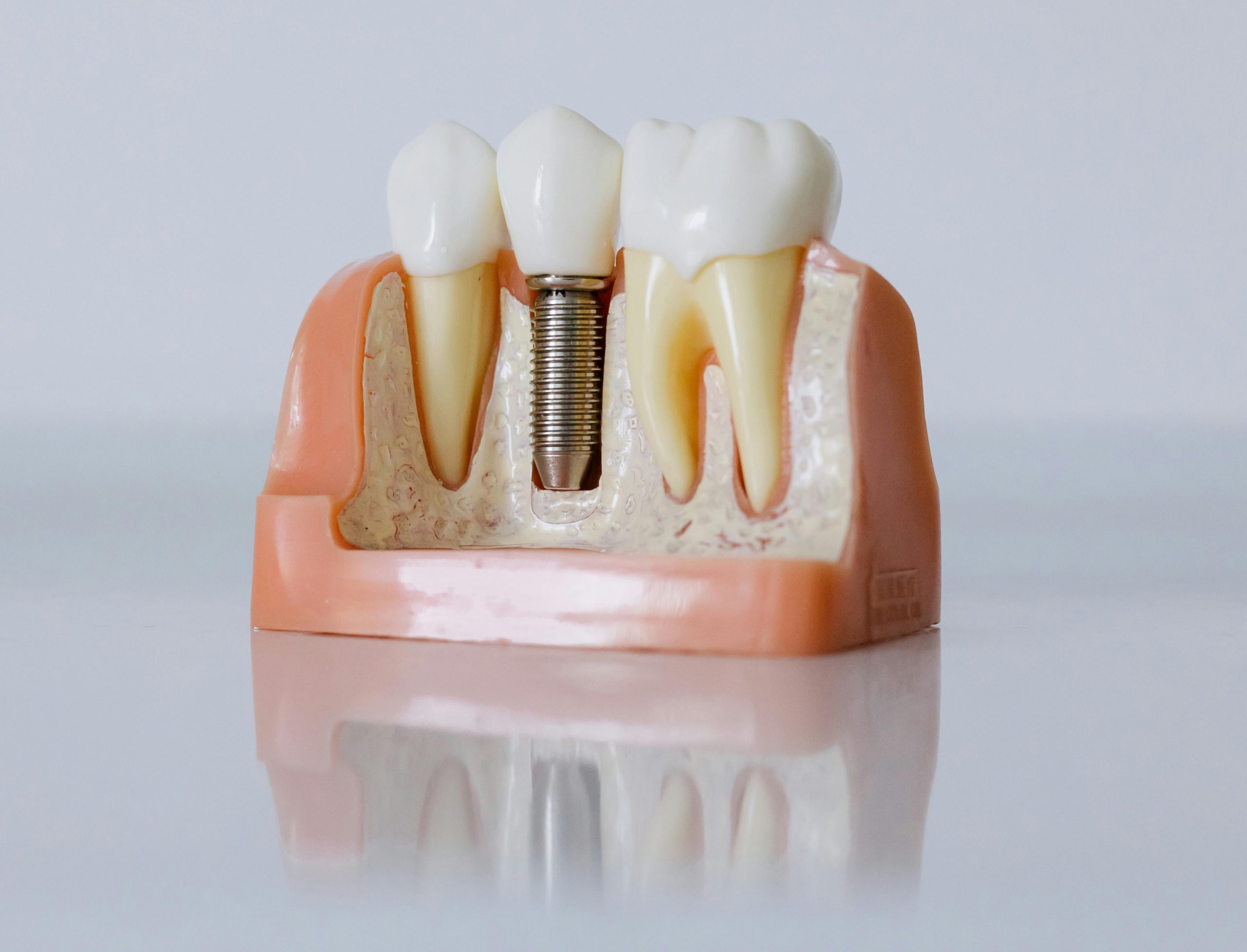 Dental implant cast model