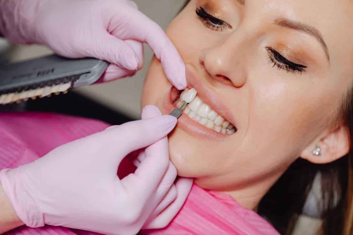 dental veneers in chicao